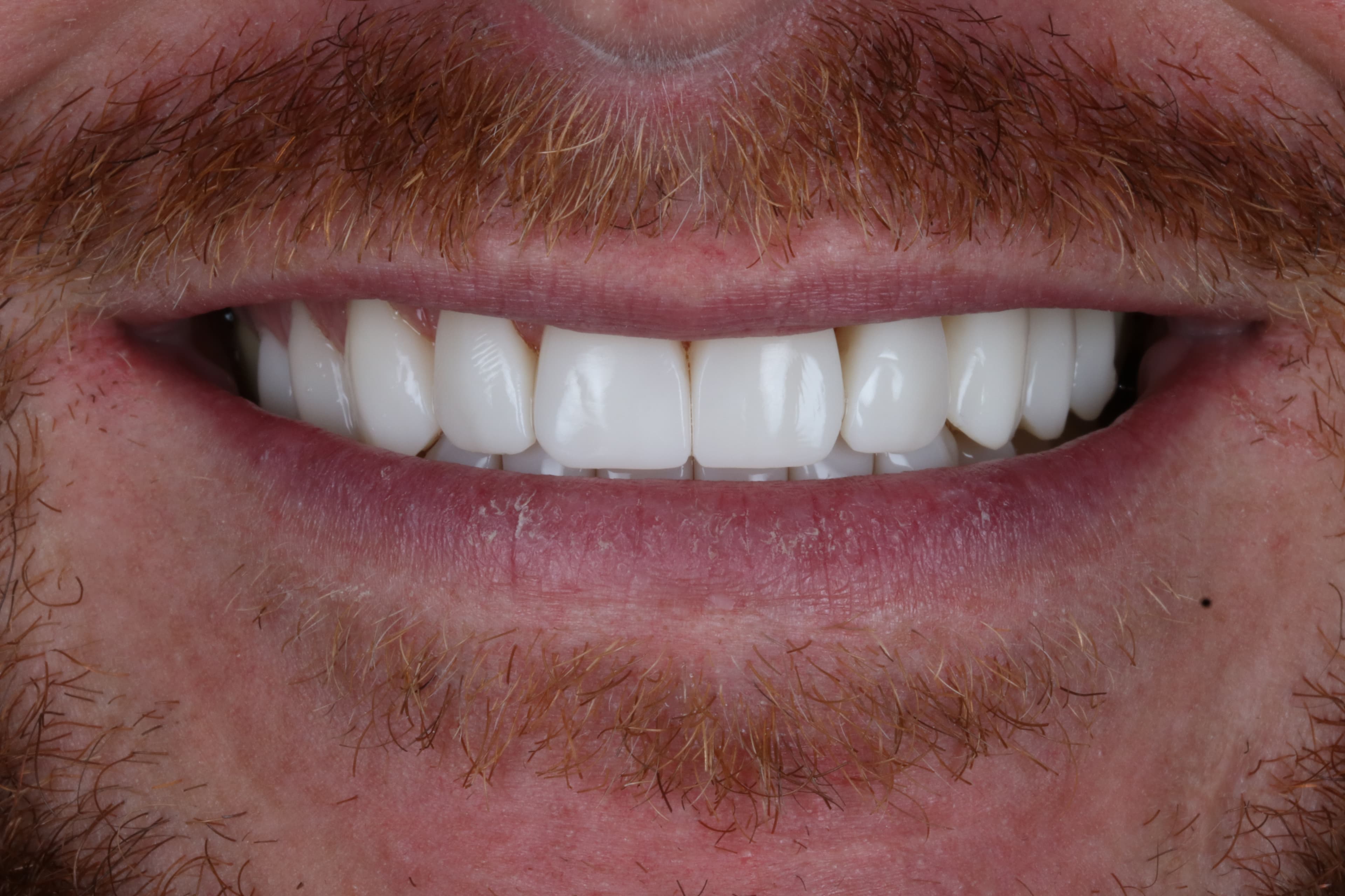 After Composite Bonding — 10 Teeth