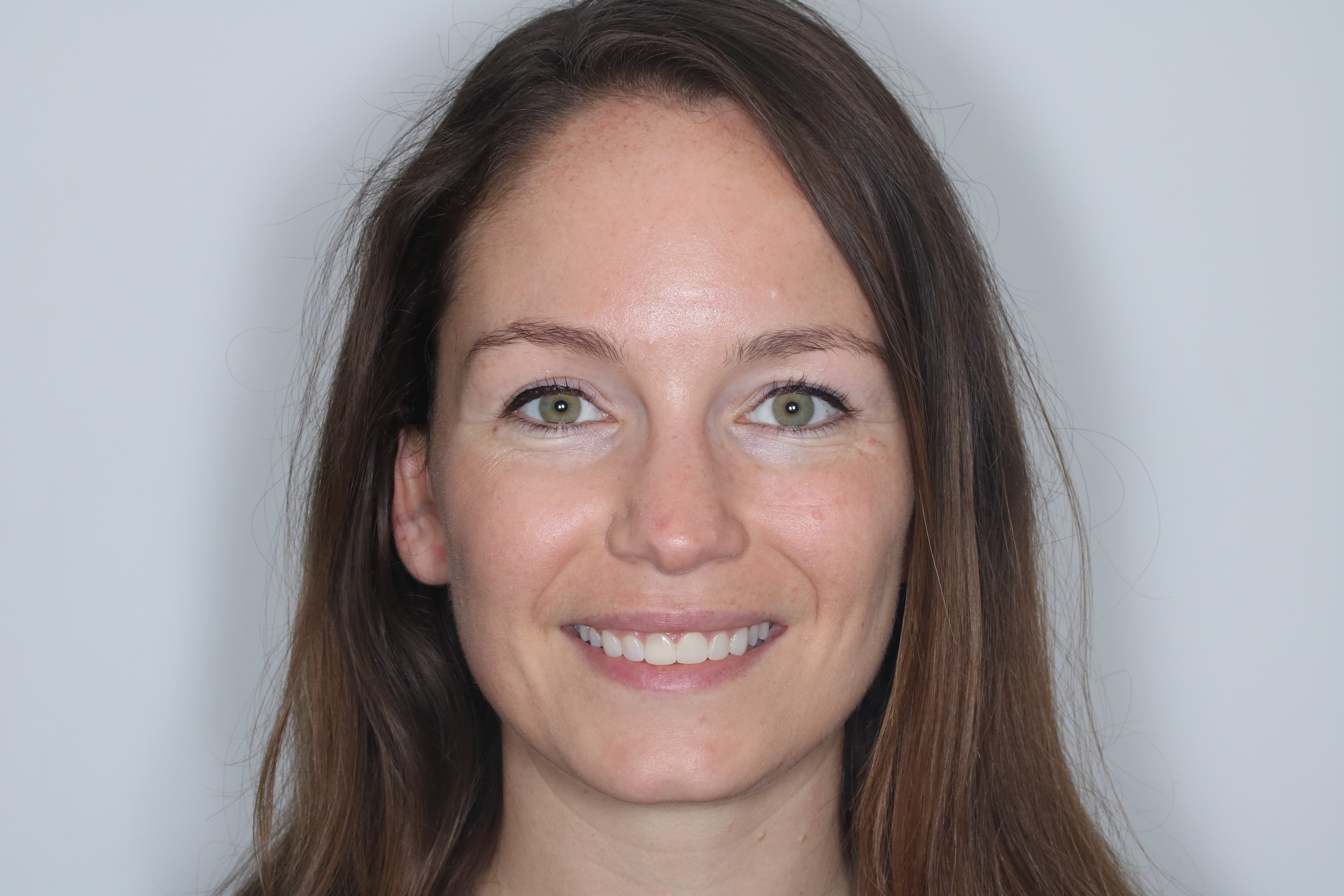 After Composite Bonding — 6 Teeth