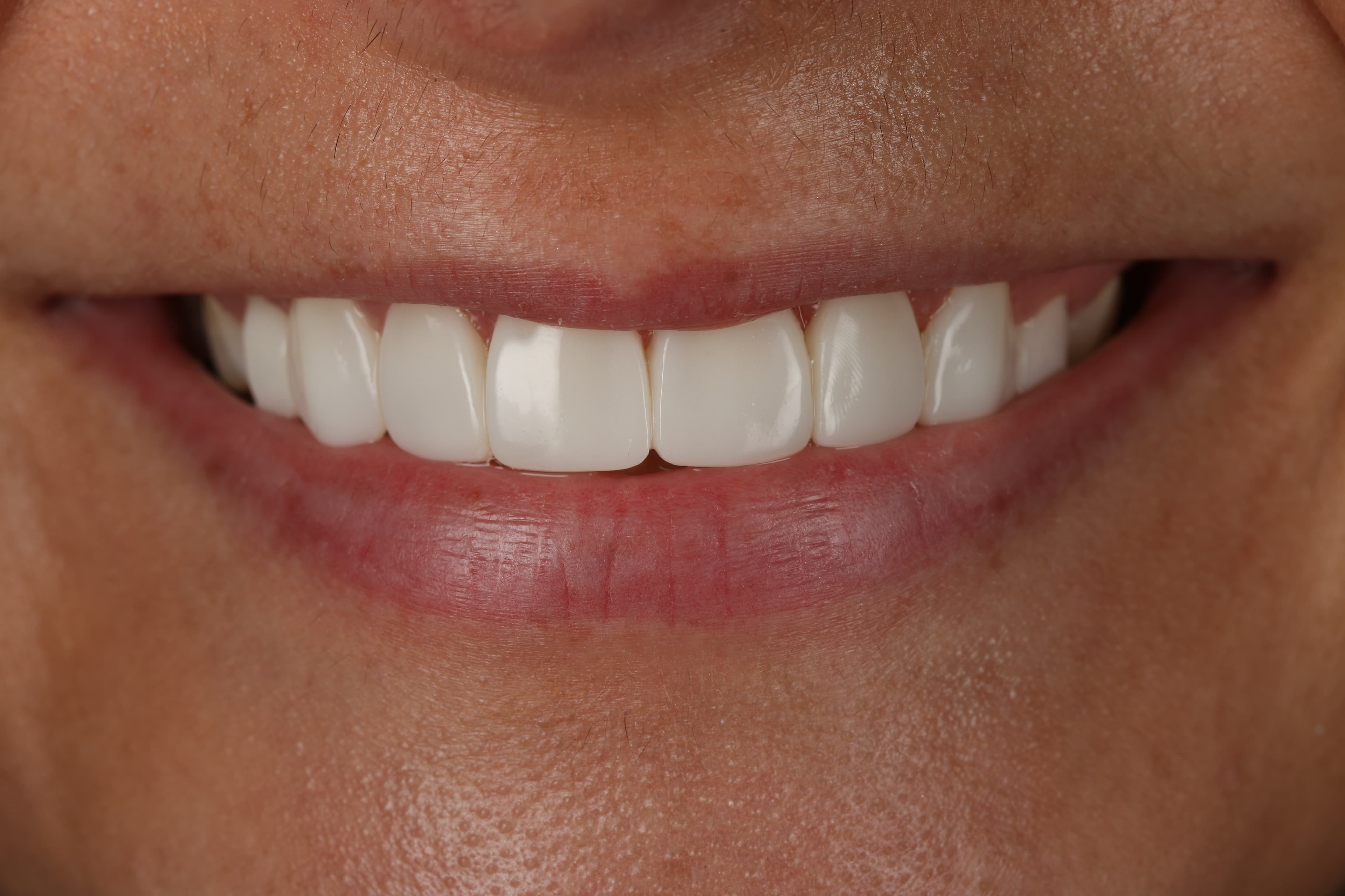 After Composite Bonding — 10 Teeth
