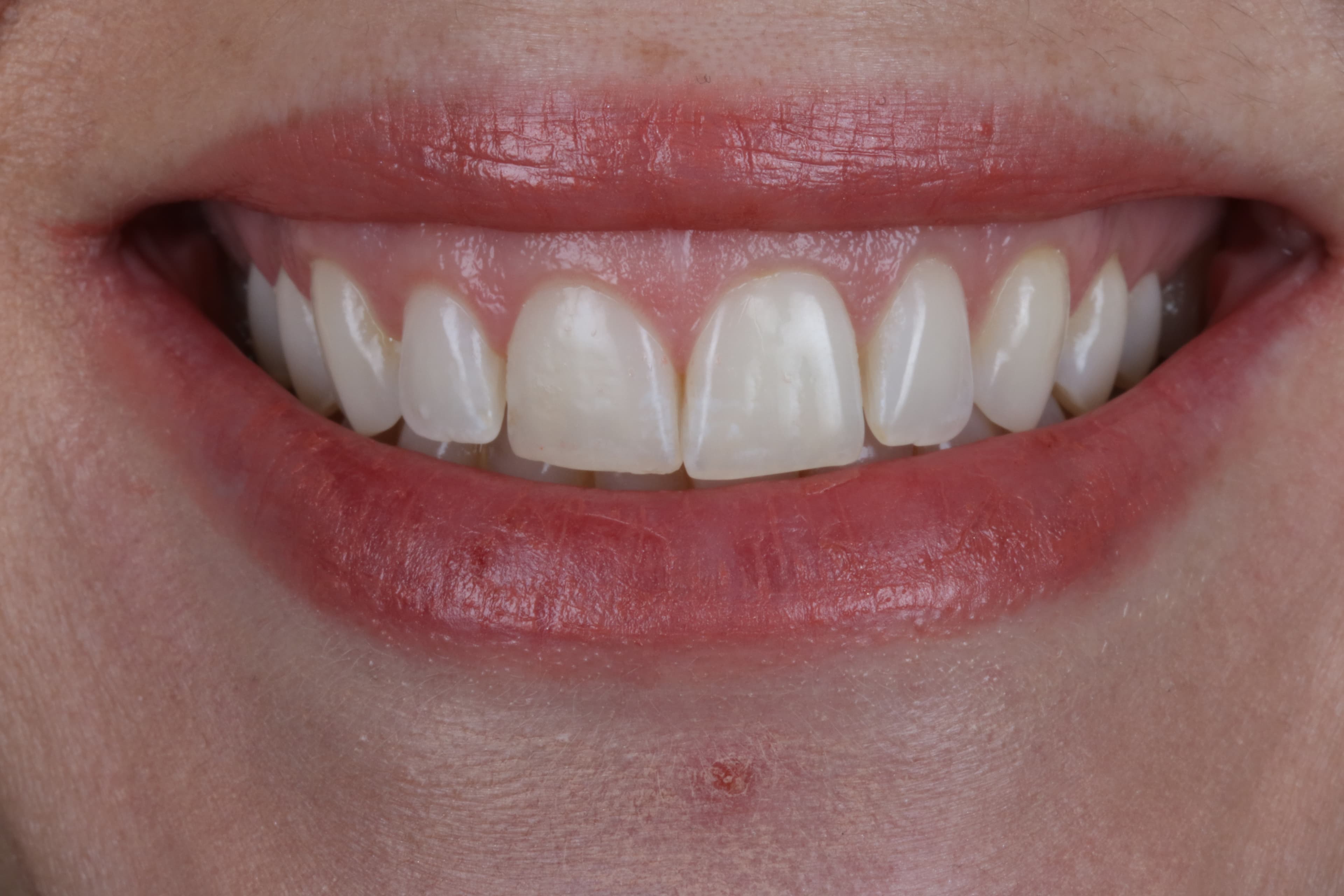 Before Composite Bonding — 8 Teeth