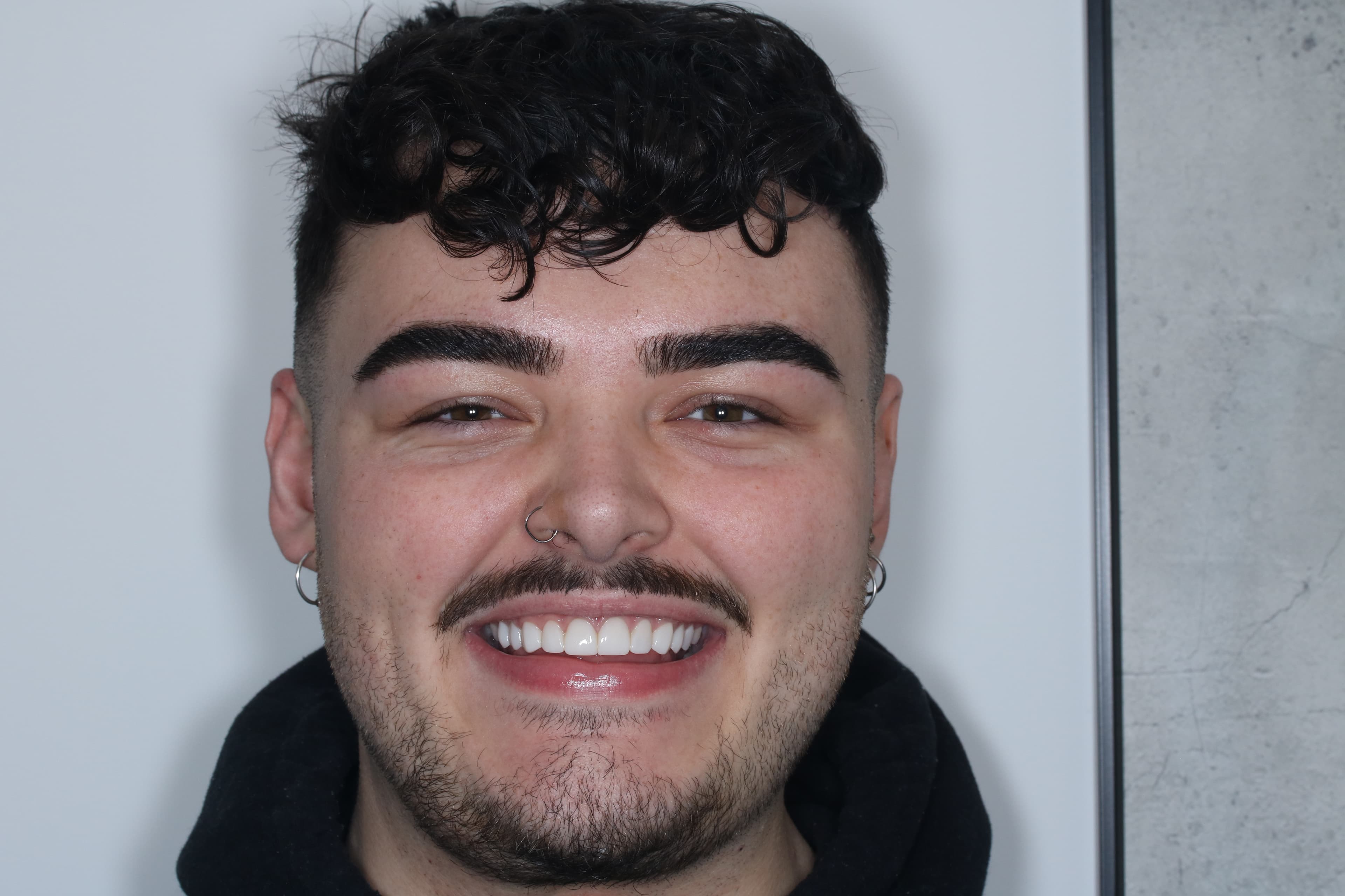 After Composite Bonding — 10 Teeth