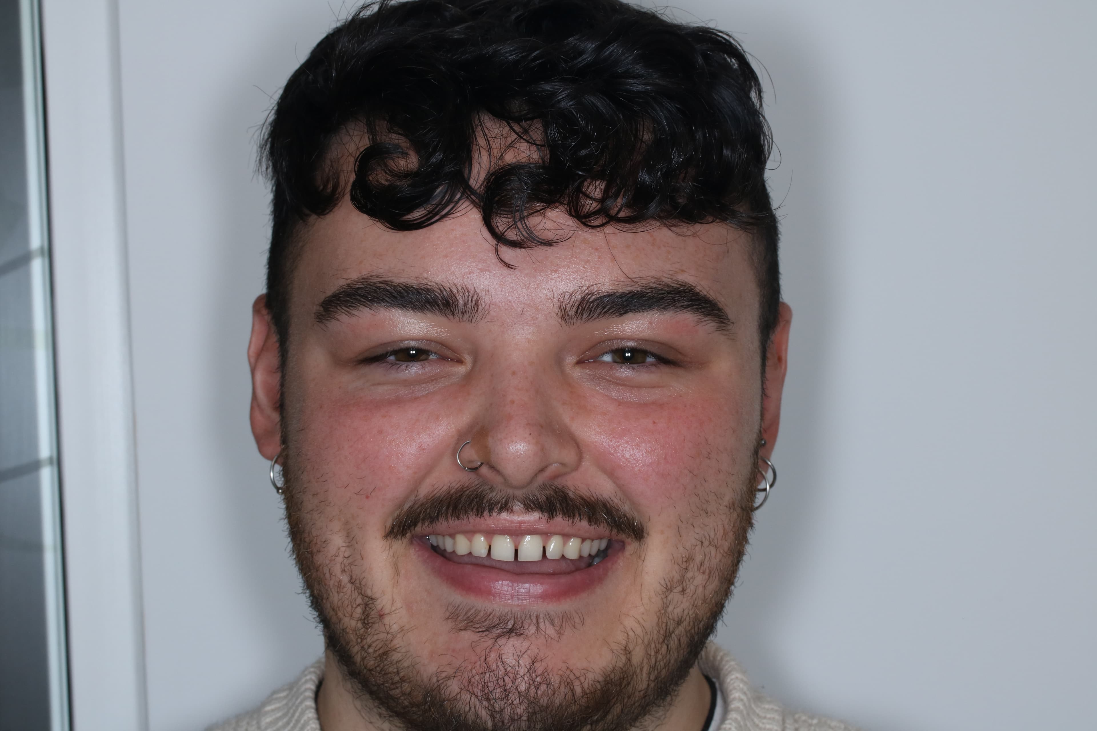 Before Composite Bonding — 10 Teeth