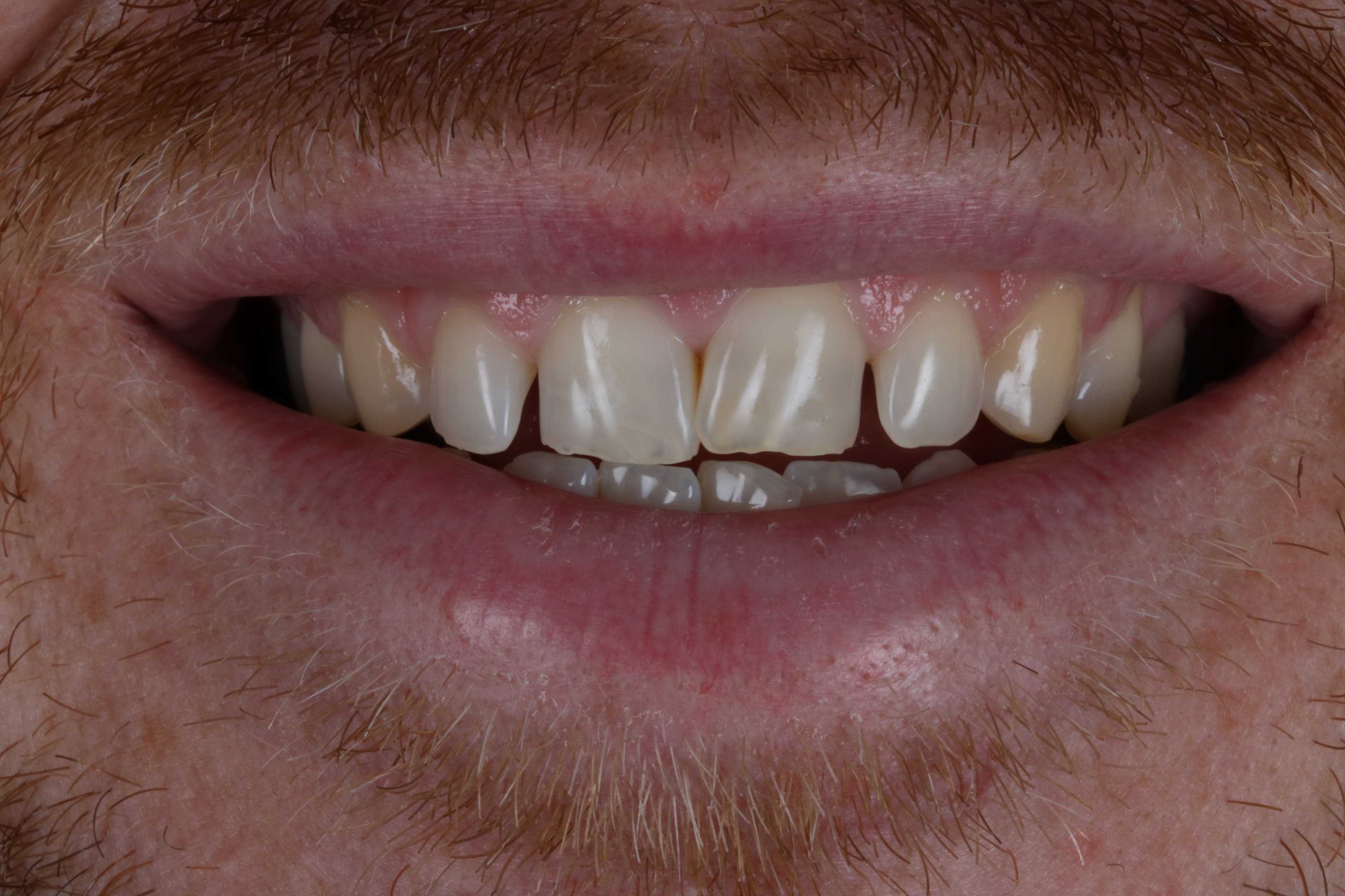 Before Composite Bonding — 8 Teeth