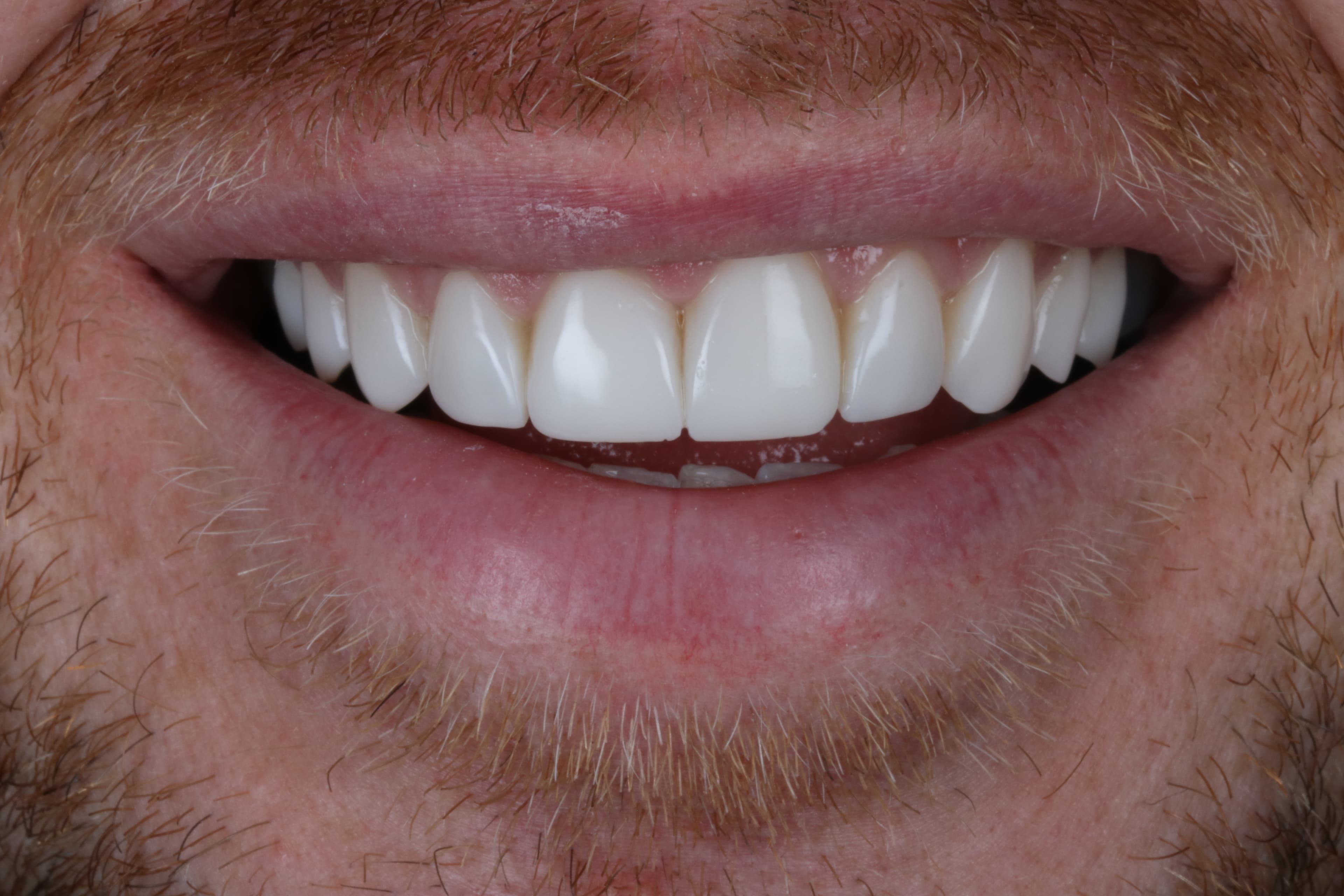 After Composite Bonding — 8 Teeth