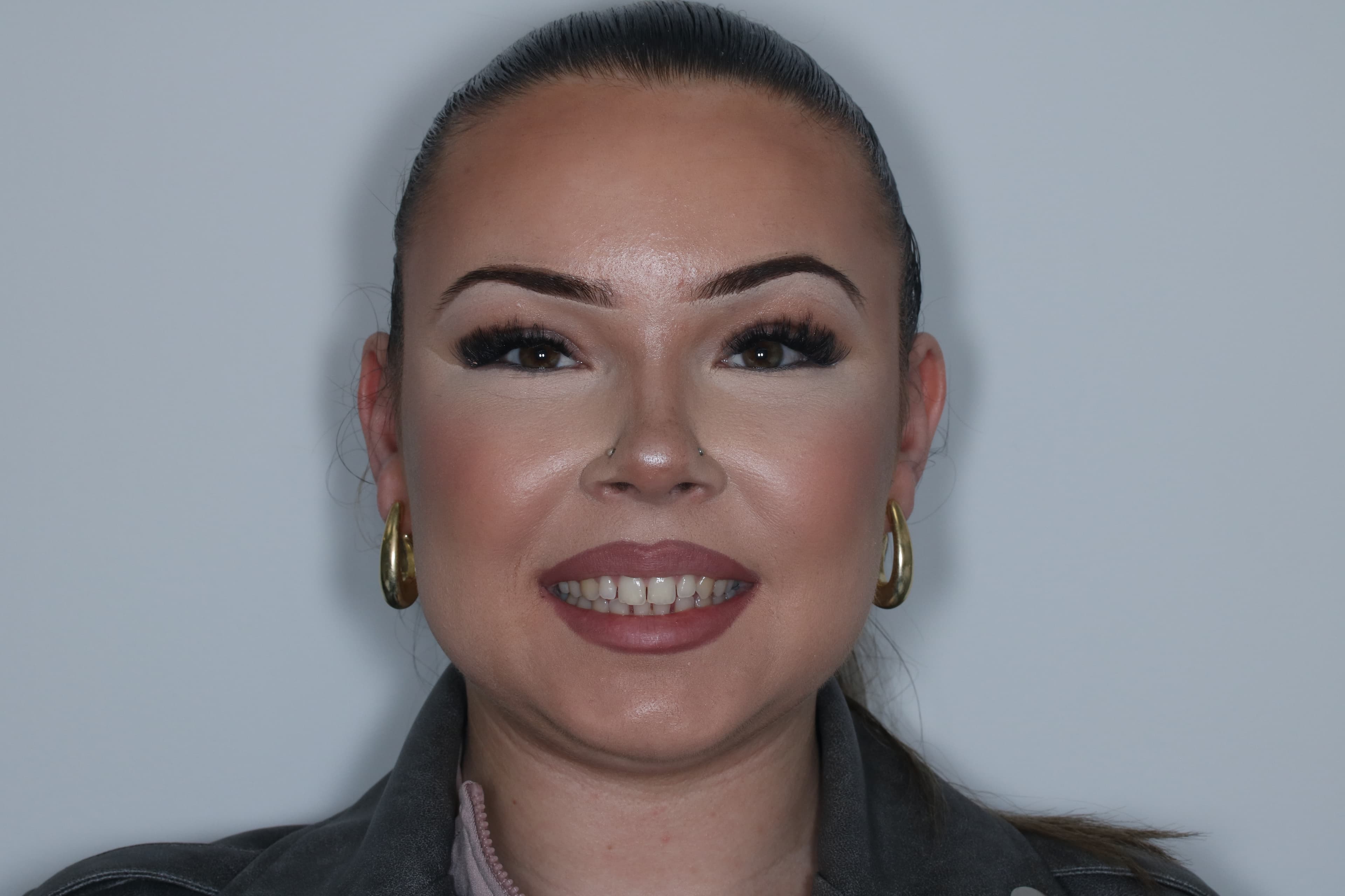 Before Composite Bonding — 8 Teeth Upper & Lower