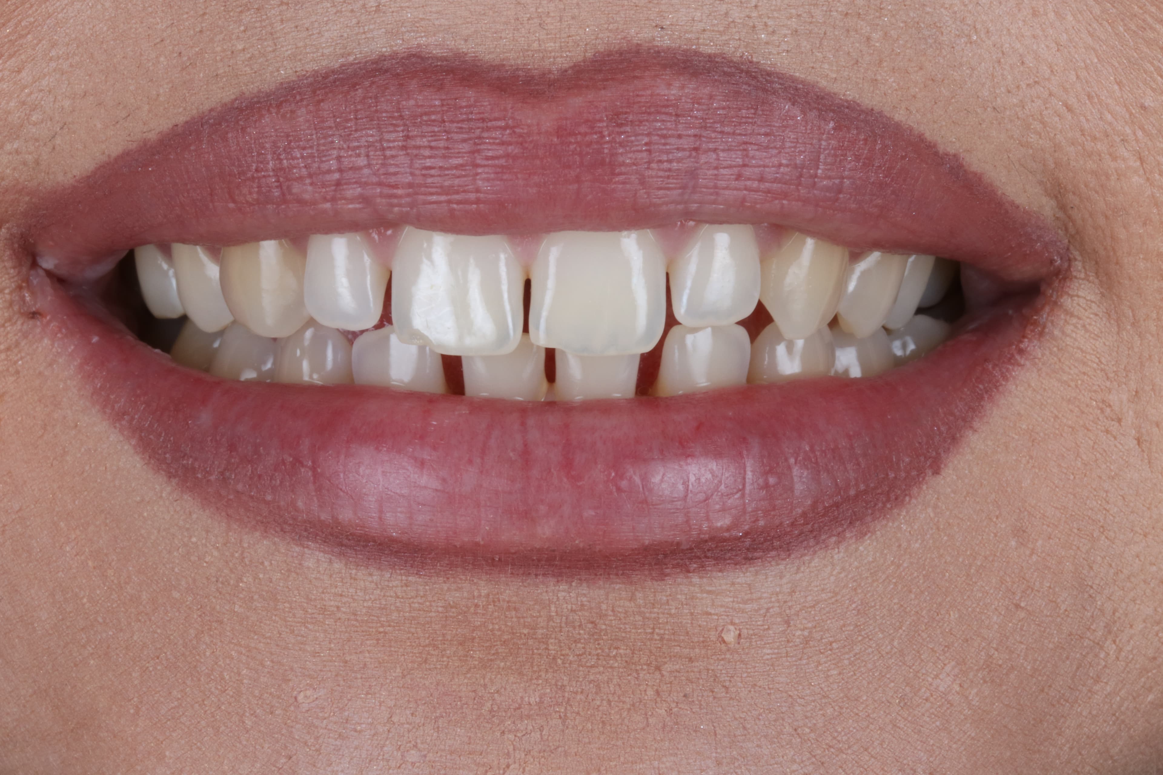 Before Composite Bonding — 8 Teeth Upper & Lower