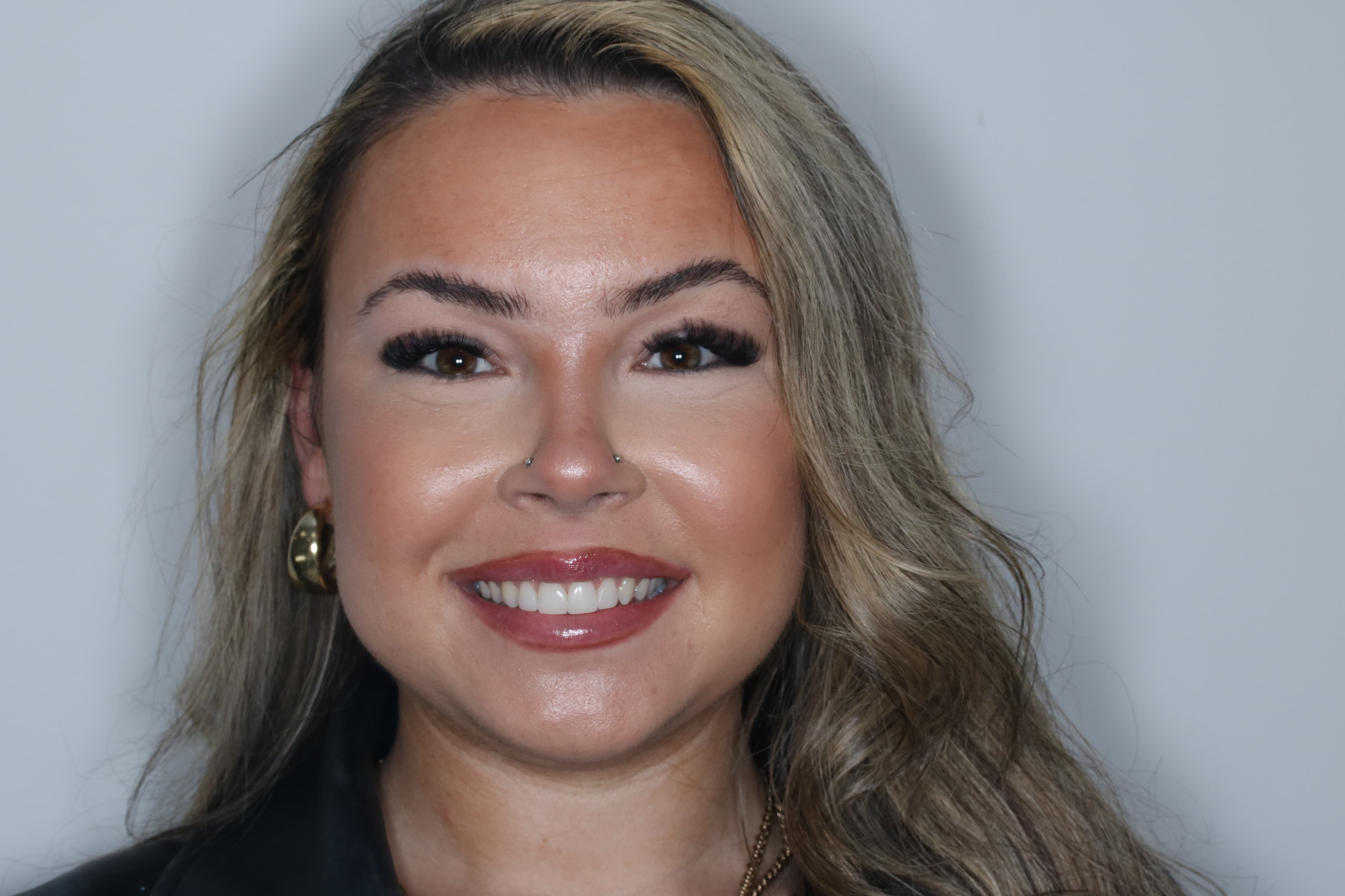 After Composite Bonding — 8 Teeth Upper & Lower