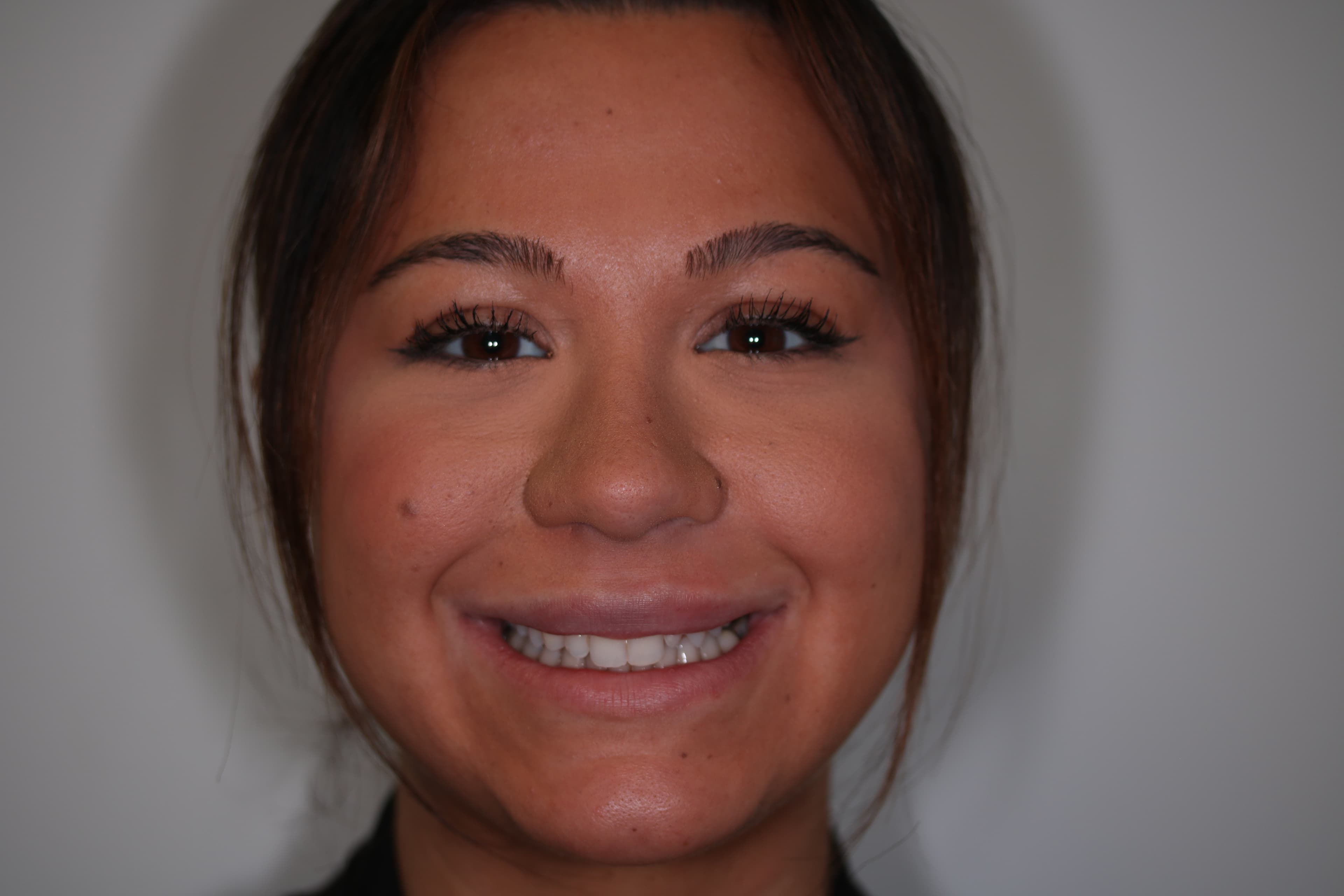 Before Composite Bonding — 10 Teeth