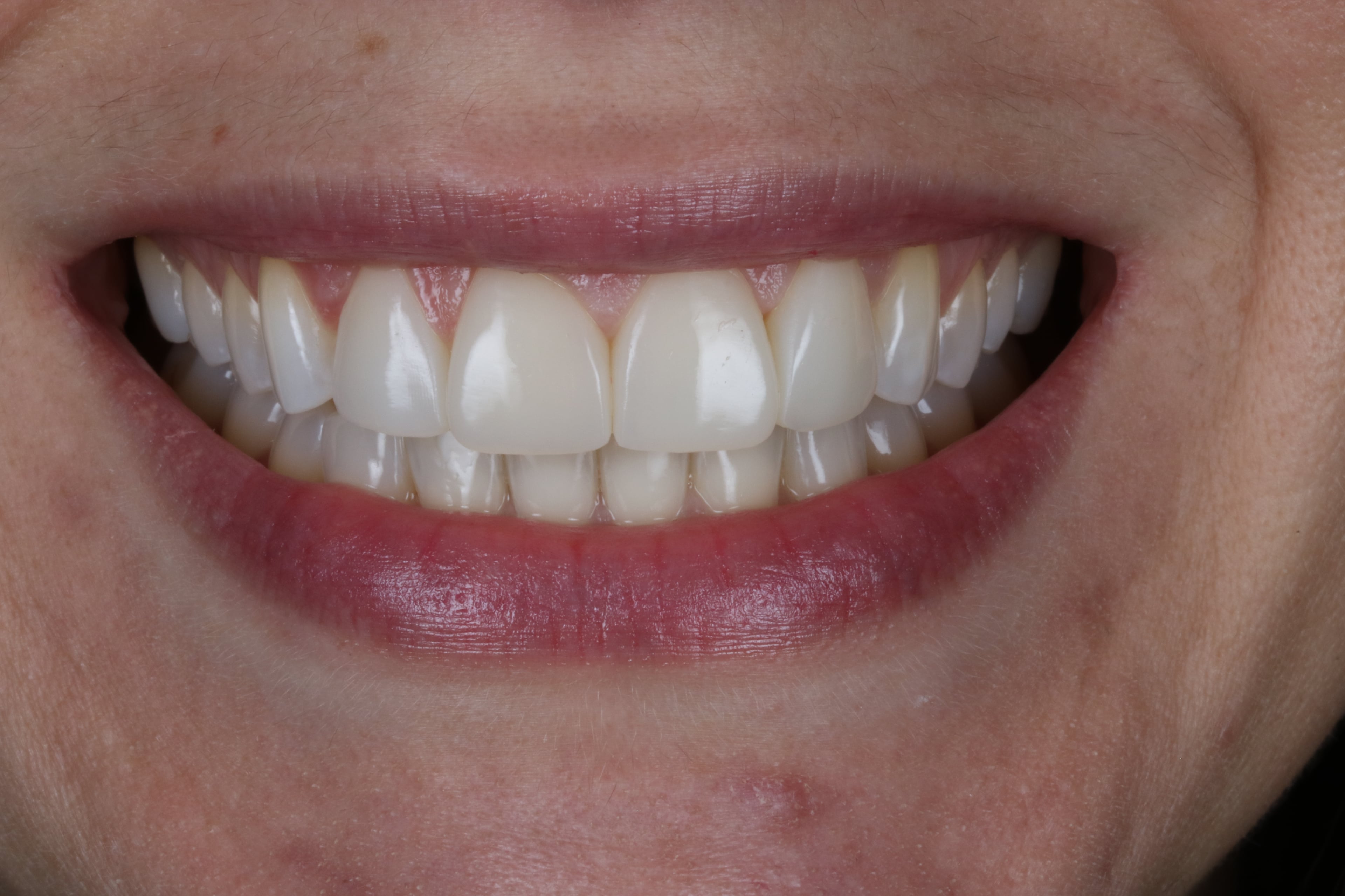 After — Composite Bonding, 4 Teeth
